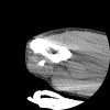 SPORK, NICO - 22.03.1976 - 02.08.2022 - CT obere Extremität - 17:51:17